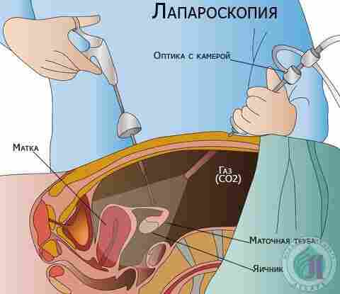 Лапароскопия